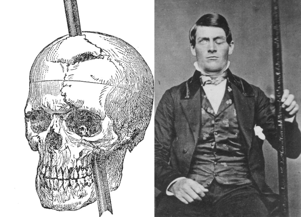 Phineas-Gage-with-skull-picture